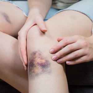 Chequeo de Coagulación